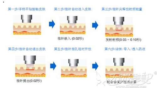 黄金微针祛痘原理