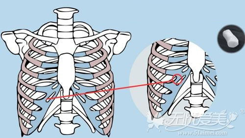 自体肋骨选取的部位
