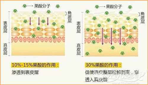 果酸焕肤美白