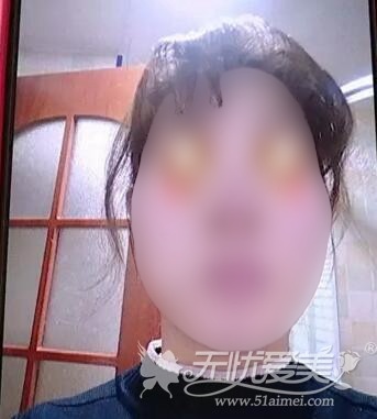 隆鼻后喝酒造成伤口红肿