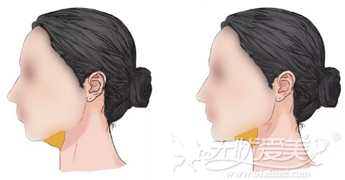 隆下巴或下颏截骨前移矫正改善双下巴