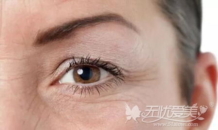 女人过了40岁上眼皮下垂 是重新割双眼皮还是做提眉手术呢?