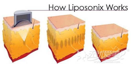 Liposonix热立塑溶脂原理