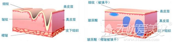 玻尿酸注射填充原理