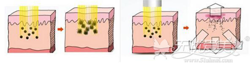 激光祛斑的原理过程