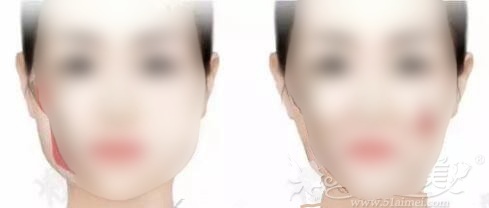 颧骨高做降低术后会导致皮肤松垂吗?还需要做面部提升吗?