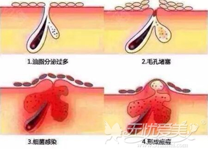 油脂分泌多造成痘痘肌