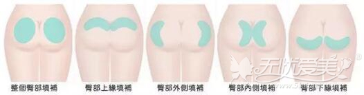 自体脂肪填充缓解臀印