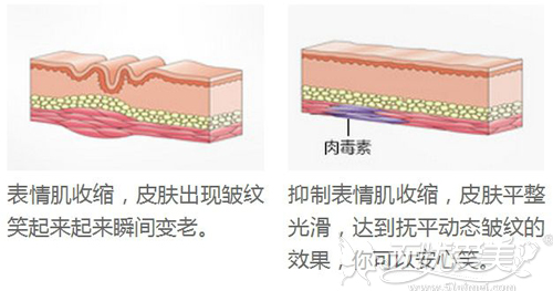 除皱针作用原理