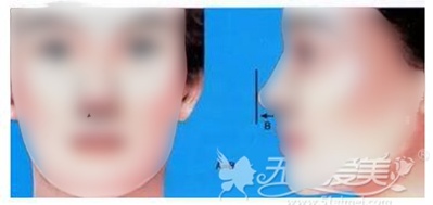 综合隆鼻手术怎么做?假体+软骨≠鼻综合 千万别被忽悠!