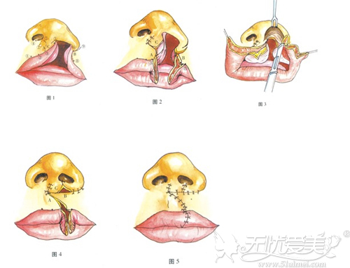 唇裂修复术原理