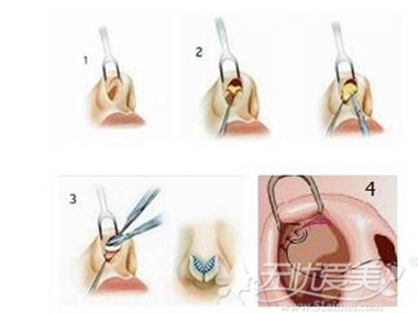 隆鼻手术鼻小柱鼻口缘切口