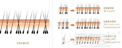植发前和植发后的毛囊情况