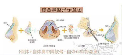 鼻综合手术原理