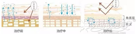 激光祛红血丝原理