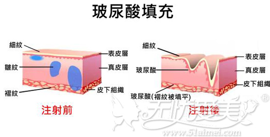 玻尿酸对我们面部的填充作用