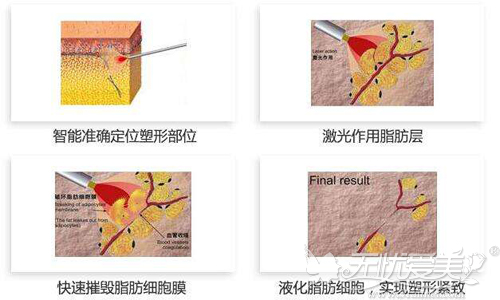 激光溶脂的手术原理