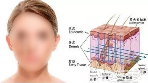 面部埋线去除嘟嘟肉的位置