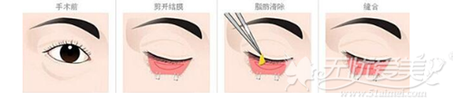 外切口去眼袋手术过程