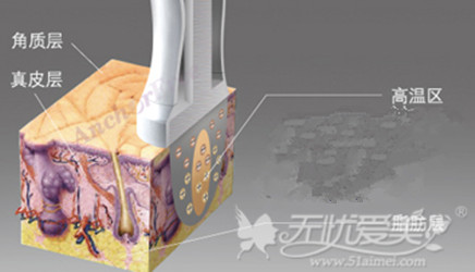 电波拉皮原理 电波拉皮原理