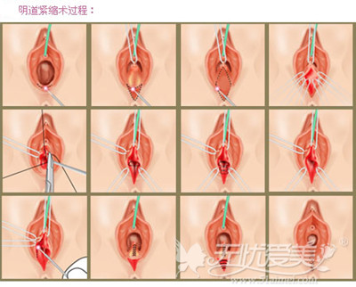 阴道紧缩术的操作流程