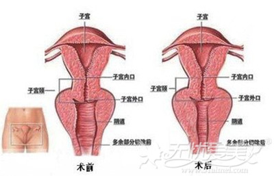 做了阴道紧缩术后效果对比