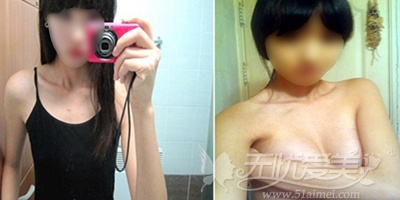 在韩国原辰做了假体隆胸手术后100天终于实现了我的模特梦