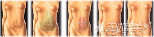 全腹壁整形手术过程原理