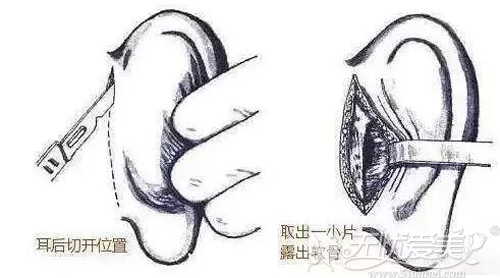 耳软骨的手术位置在耳朵后面，不留痕迹