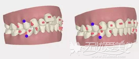 隐形矫正和固定矫正前矫正方案的设计