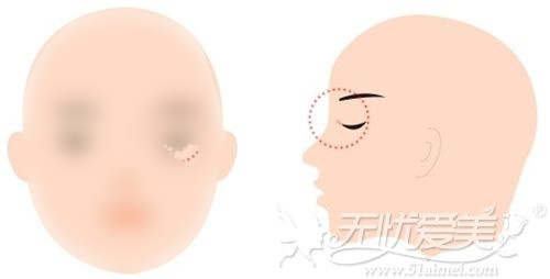 做开眼角留下疤痕？韩式开眼角疤痕修复针能帮你去除