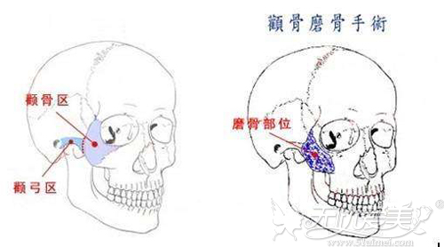 颧骨颧弓整形能不能解决颧骨高、弓宽等问题？