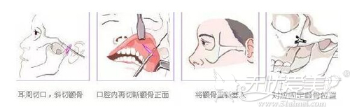 颧弓内推手术过程