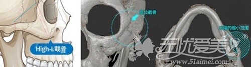 韩国High-L颧骨缩小术一次就能改善颧骨高颧弓宽的问题