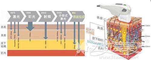 超声刀除皱的原理