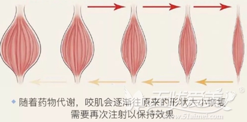 注射瘦脸针的原理