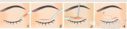 内双眼睛做全切双眼皮手术效果好