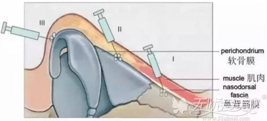 注射隆鼻中玻尿酸注射的位置