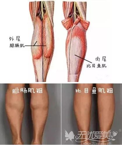 肌肉型小腿粗原因