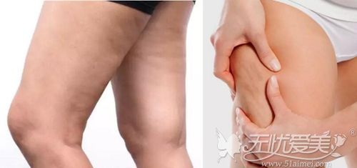 大腿肥胖纹怎么消除 除了抹精油外还能借助激光、果酸换肤