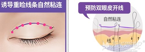 韩国Seven-Lock双眼皮手术过程