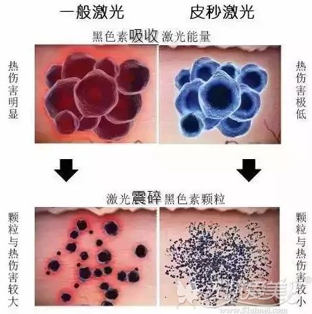 皮秒设备祛斑的优势