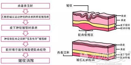 瘦脸针注射除皱