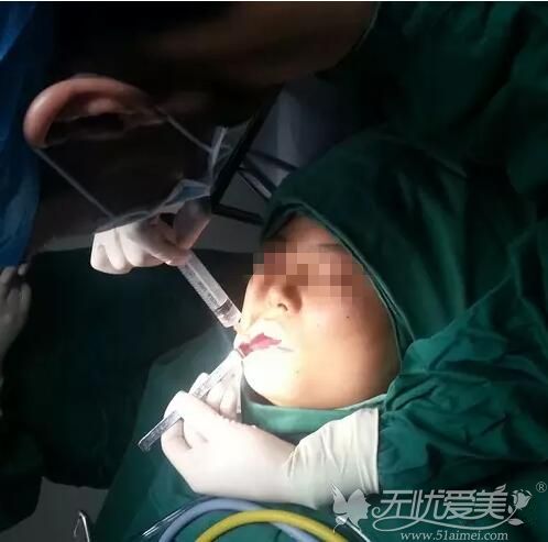 磨骨手术过程经历图证明下颌角取走后面颊不会凹陷