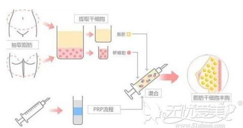 自体脂肪隆胸过程