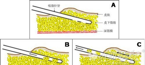 节后整形攻略：如何轻松把肥胖、痘痘、黑眼圈赶走