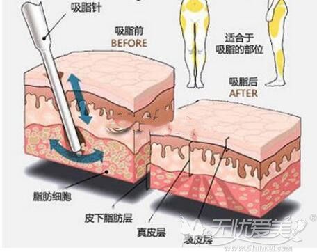 腿部吸脂术