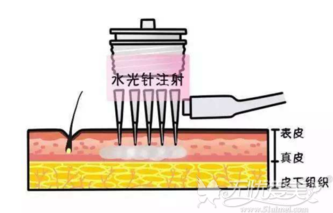 水光针原理