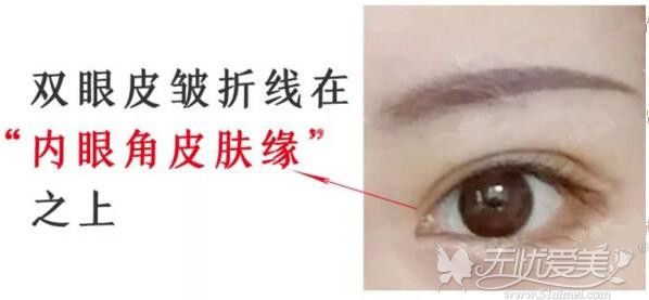 双眼皮平行扇形哪个好看?网红欧式平行割8㎜合适吗?