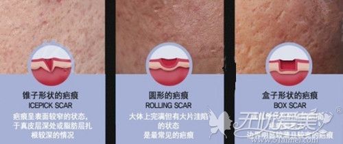 韩国皮下分离术可以改善都可能类型